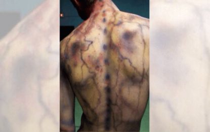 Fibromialgia en Mendoza: el dolor de no ser escuchadas