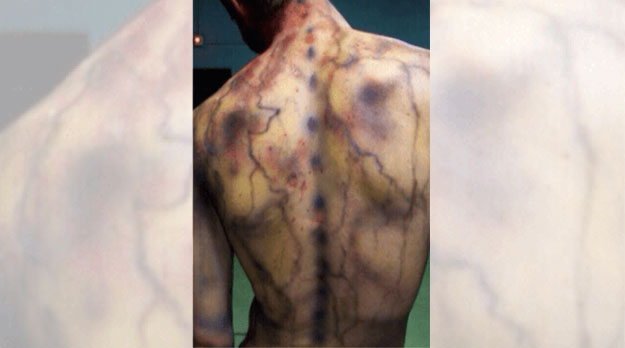 Fibromialgia en Mendoza: el dolor de no ser escuchadas